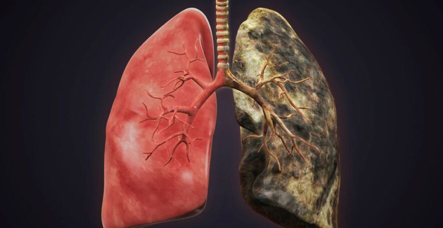 smoker's lung and quit smoking lung