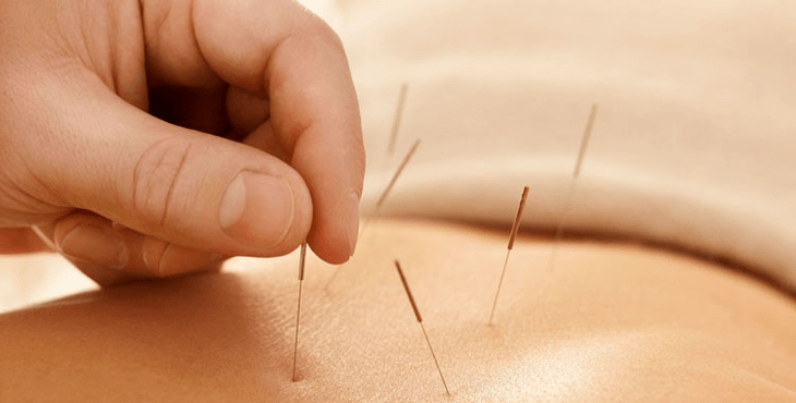 acupuncture against smoking